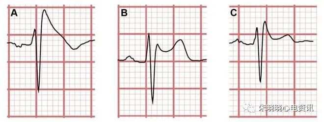 典型 Brugada 综合征伴明显下壁导联心电图动态变化