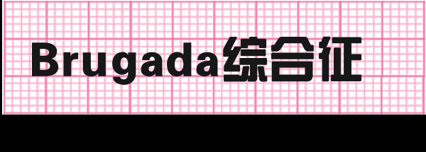 典型 Brugada 综合征伴明显下壁导联心电图动态变化