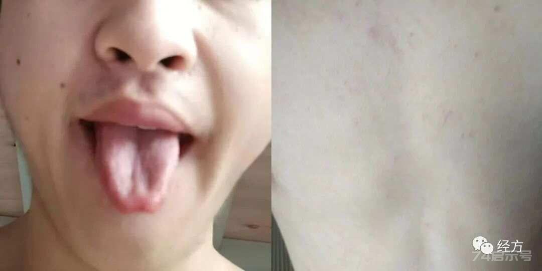 遍身红疹伴汗后剧痒数天→新加汤→患者肤白体瘦，舌淡、脉用力方