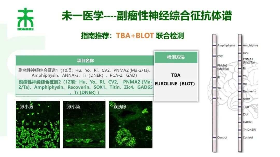 诊断标准副肿瘤性神经综合征最新诊断标准（2021）