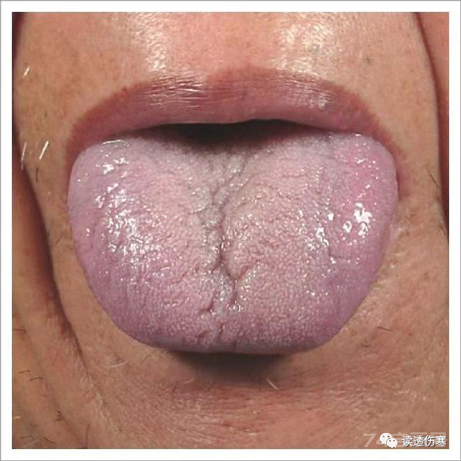高血压的本质是血管堵，不懂疏通血管，吃一百年降压药还是白搭！