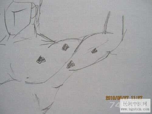 20100529少阳老师黄元御临证经验谈——疱疹热毒伤阴辨治