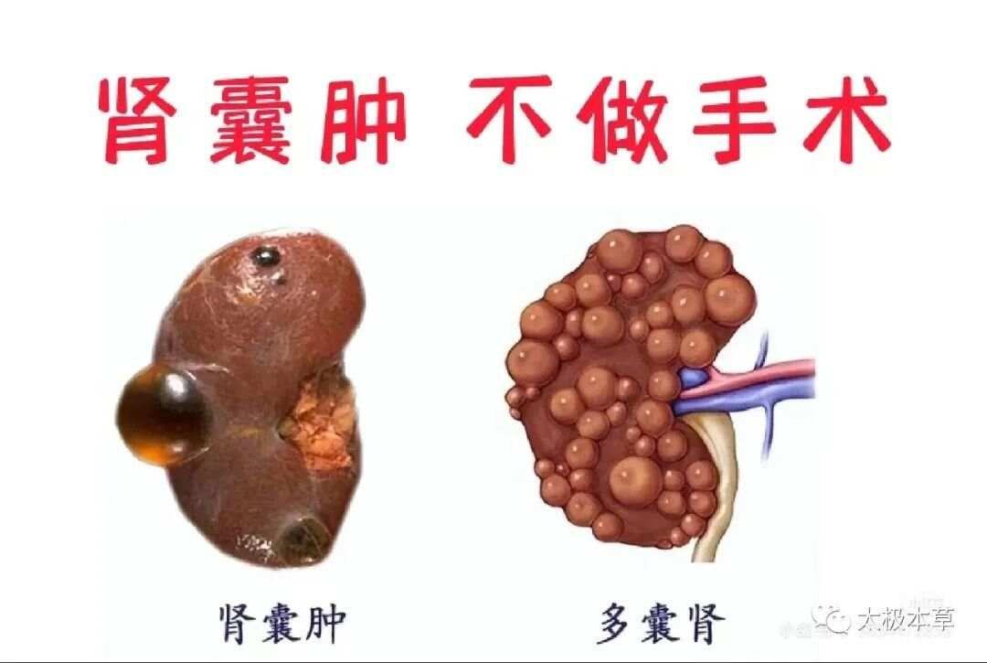 肺结节，不用怕！咱老百姓有验方与成药