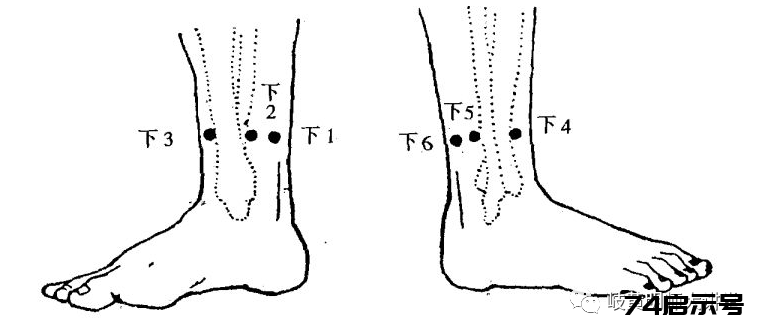 腕踝针的身体分区和进针点图解