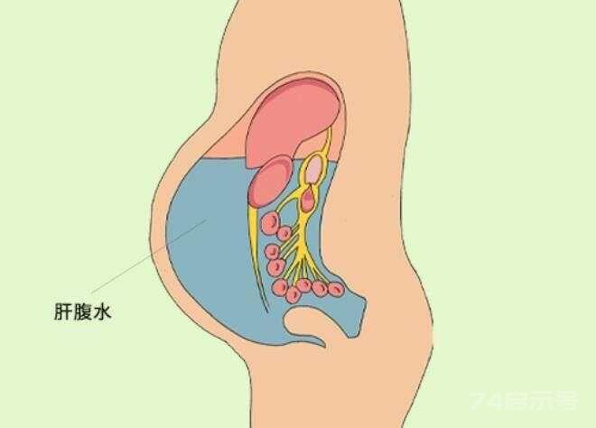 晚期肝硬化恶性腹水验方