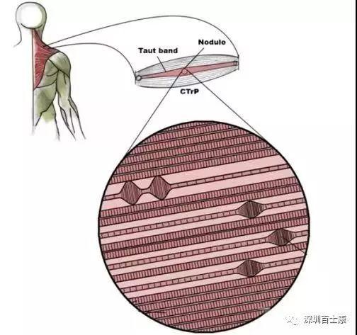 筋膜的粘连及松解治疗