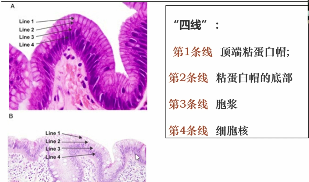 胃活检异型增生病理学习