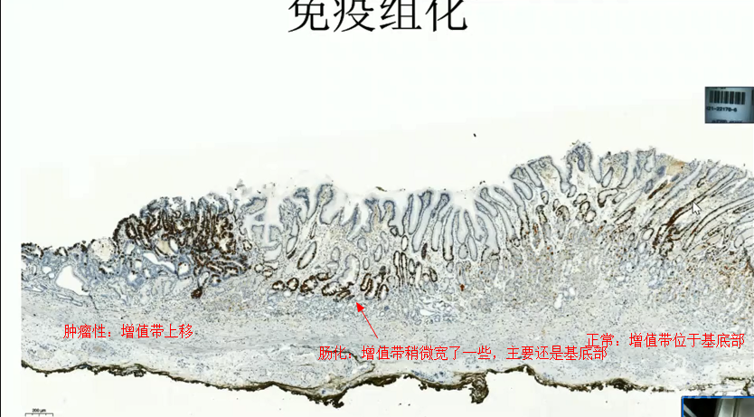 胃活检异型增生病理学习