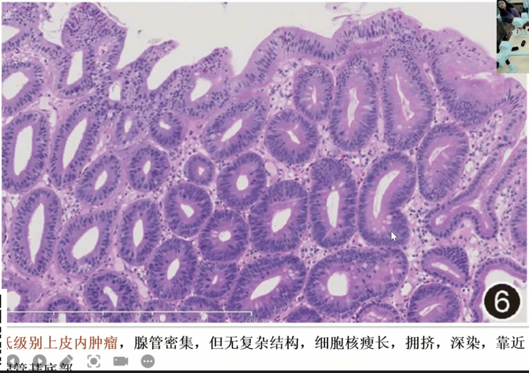 胃活检异型增生病理学习