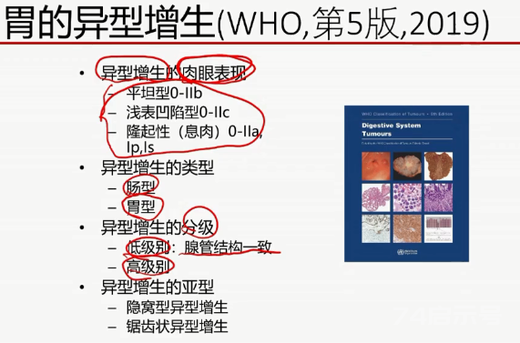 胃活检异型增生病理学习