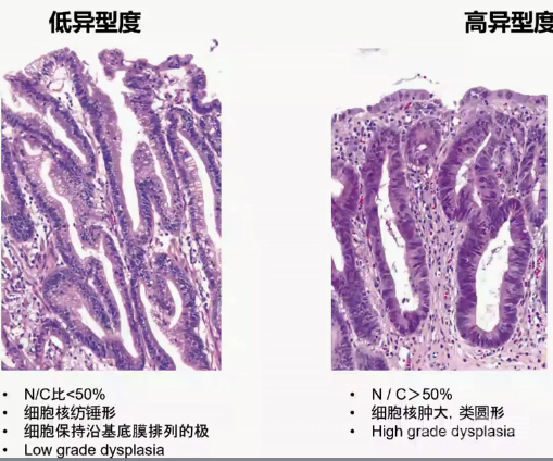 胃活检异型增生病理学习