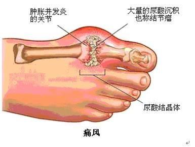4味中药治痛风，有效率99%!