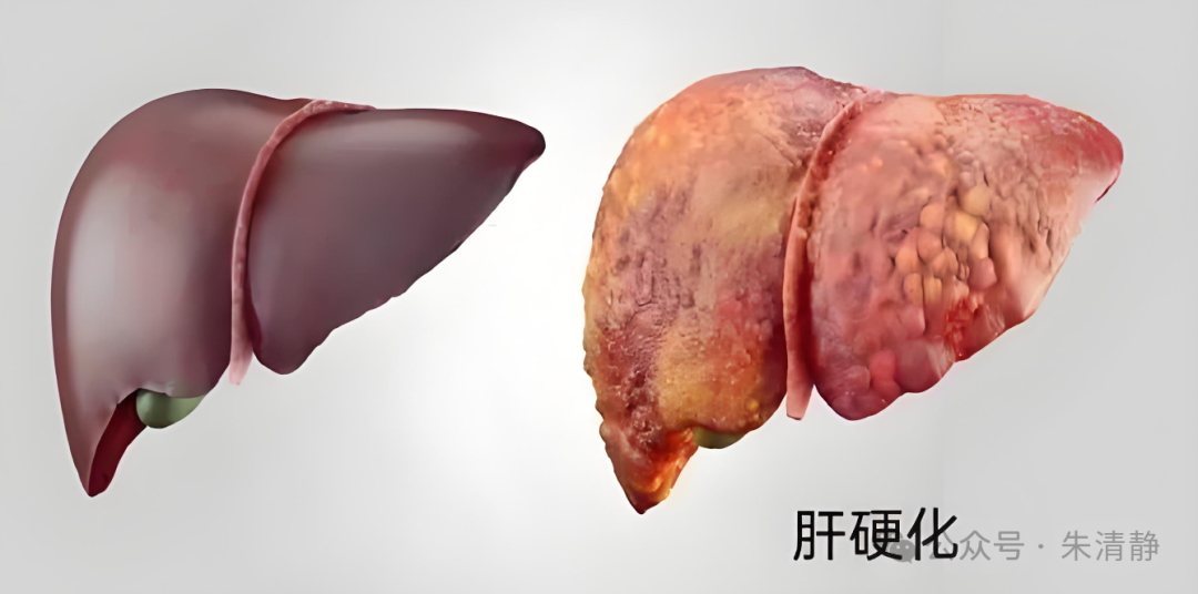 问题在于这跟它的肝硬化有关系吗上热下寒意味着什么