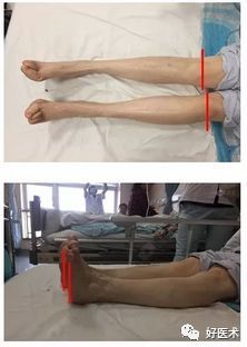 关节置换手术标准操作规程__关节置换疗效判定和评估方法