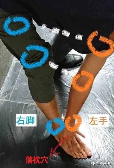 从董氏奇穴看“落枕穴”的拓展应用