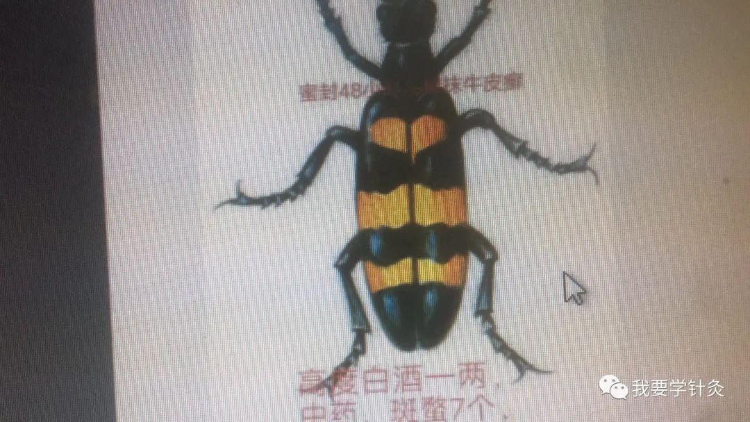 牛皮癣针法_牛皮癣针法_