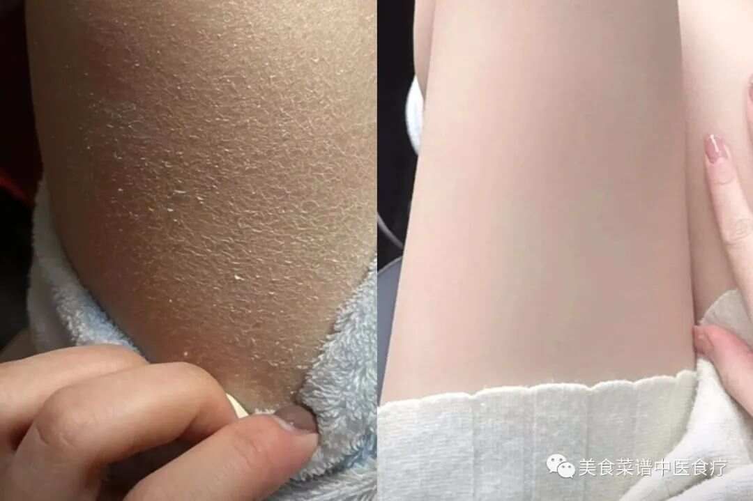 一张根治皮肤瘙痒的中药方，彻底解决秋冬季皮肤干燥瘙痒， 恢复光