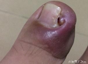 三味不起眼的中药，药少力专，专治手足湿疹、足癣，甲沟炎！