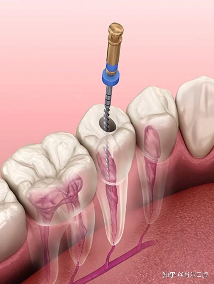 根管治疗大解密